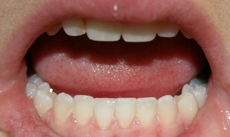 Composite-Filling-After-Image