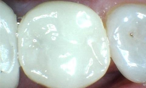 A-Broken-Tooth-Repaired-With-A-Beautiful-Metal-Free-Crown-After-Image