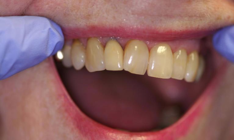 Implant-and-Crown-After-Image