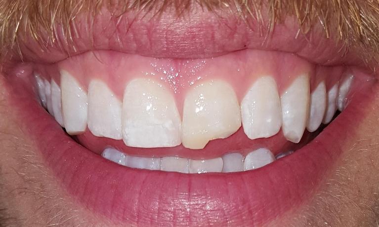 Composite-Filling-Before-Image