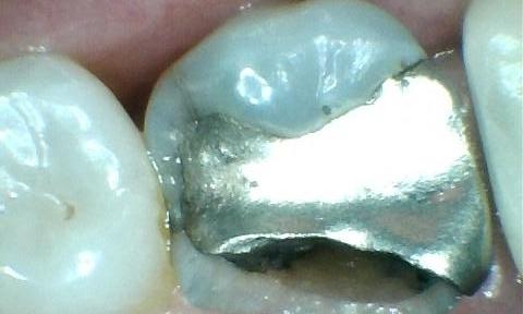 A-Broken-Tooth-Repaired-With-A-Beautiful-Metal-Free-Crown-Before-Image