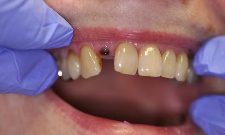 Implant-and-Crown-Before-Image